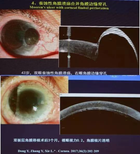 5先天性角膜穿孔伴虹膜脱出手术治疗采取穿透角膜移植 虹膜周边切除