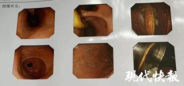 大妈吞下14厘米长牙刷没当回事,淡定了9个