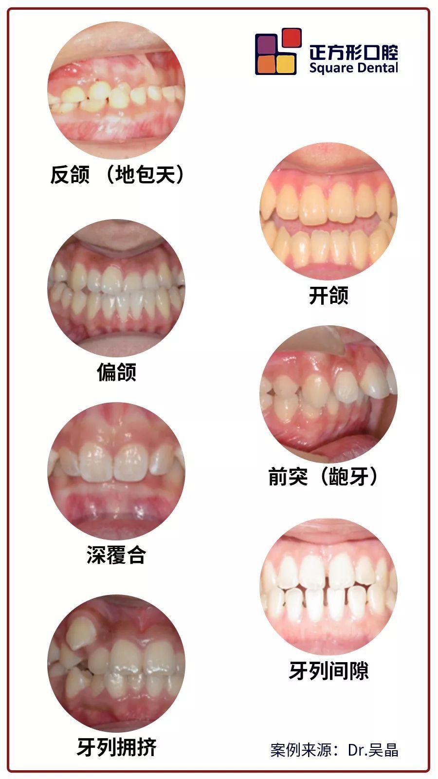 关于牙齿矫正,那些你不知道的坑 (转载)