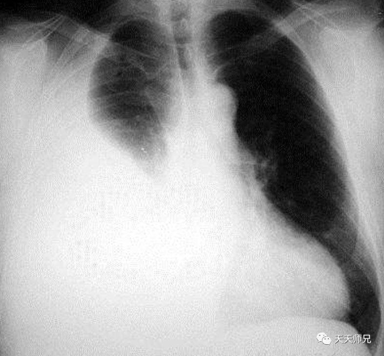 天天师兄说明: 胸腔积液:临床表现里应该要告知呼吸困难,典型胸片是