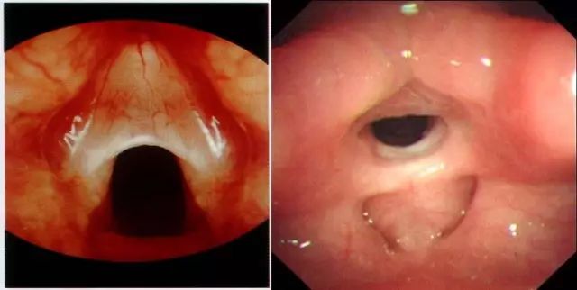 畸形:喉蹼,喉软骨畸形,喉瘢痕狭窄.