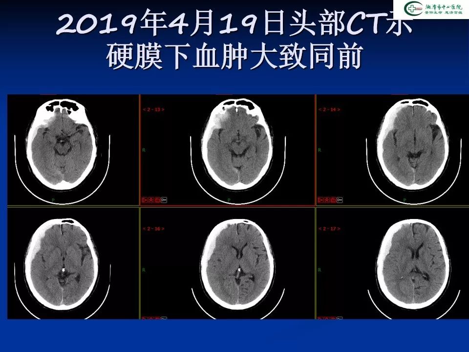 硬 膜 下 出血