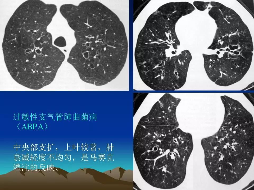 肺弥漫性病变的临床影像诊断(二) | 影像天地