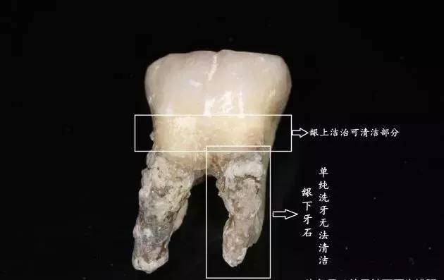 龈下结石你看不见的杀手 猜猜颗牙齿最严重?