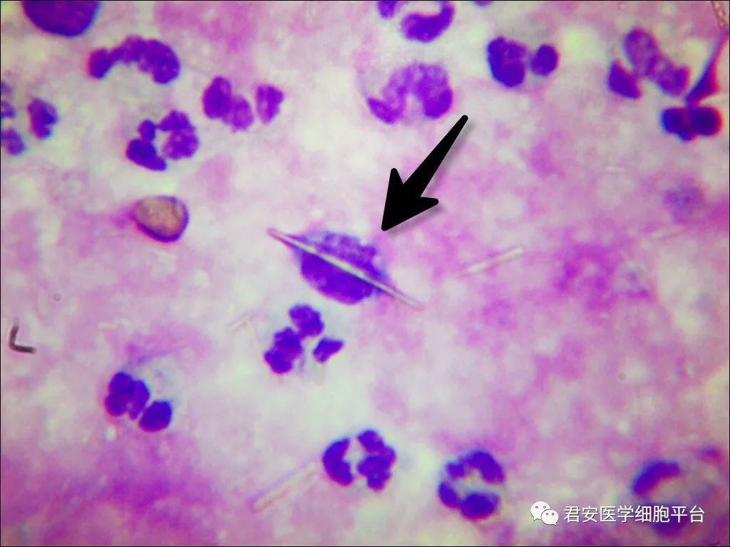 44×109/l,中性粒细胞 72%, 单核吞噬细胞 16%, 淋巴细胞 2% ,红细胞