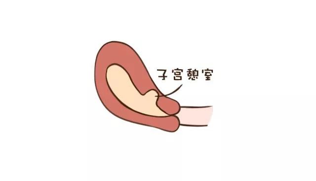 剖宫产切口瘢痕憩室——小小的星星之火可以惹出燎原之祸!