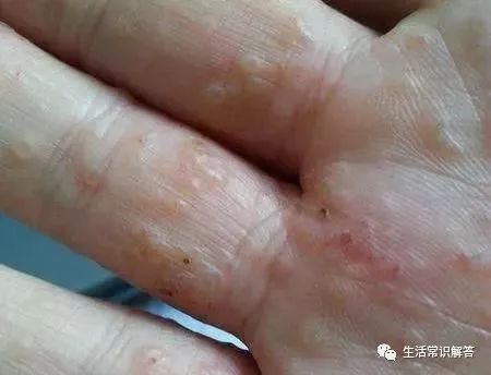 手上冒出小水泡,年年反复?医生:这3点需警惕,可能常被