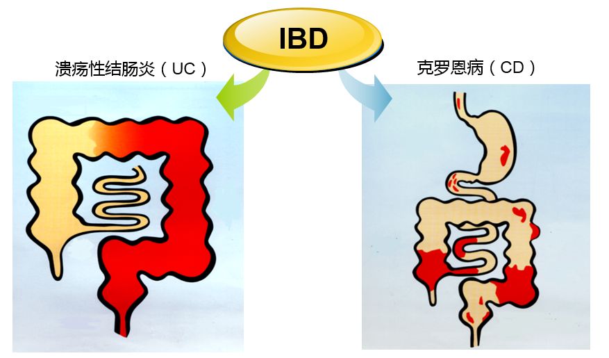 武田新知丨一文带你get炎症性肠病