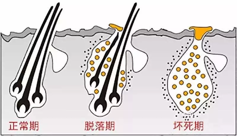 头发毛囊坏死怎么办