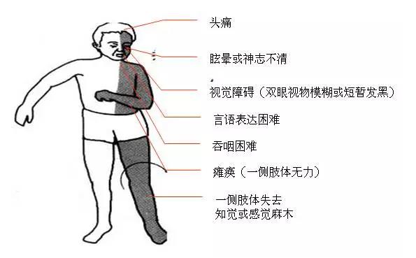 怎么预防脑梗的再次复发 09000f9756c748b0a2e171765c5a850a.jpeg