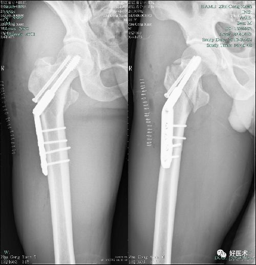 稳定的股骨粗隆间骨折治疗方法 130d314170194685b3fc7dcdaca173ec.jpeg