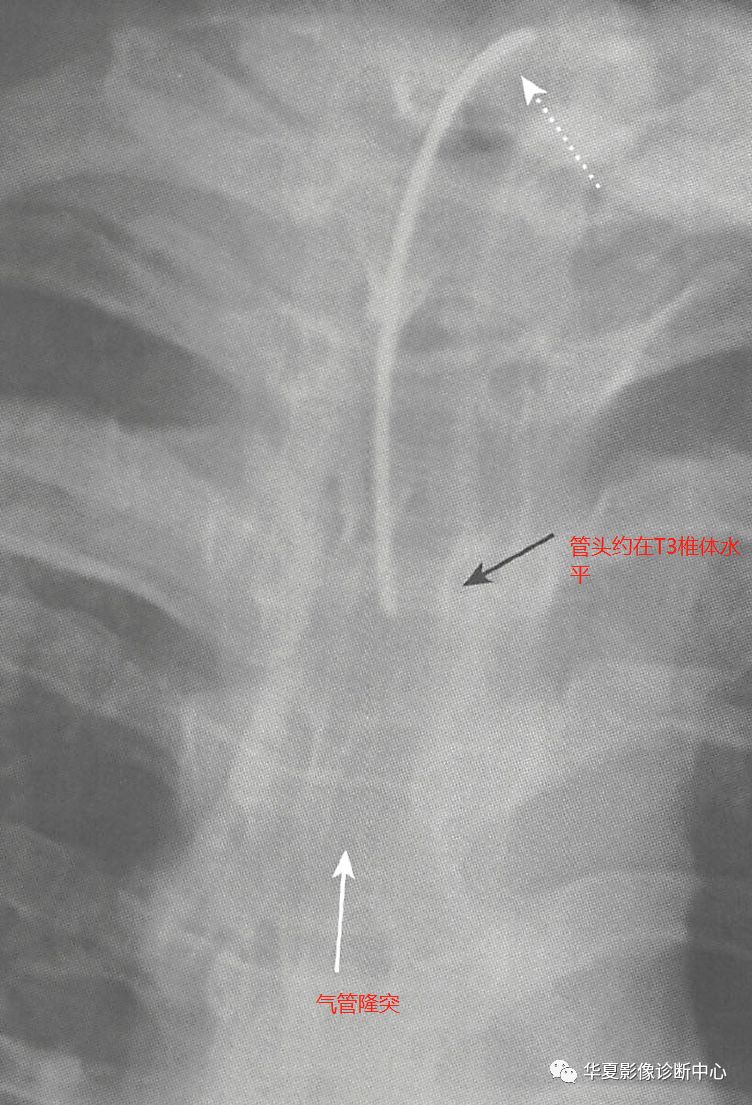 影像基础胸部常见置管的正确位置影像判断