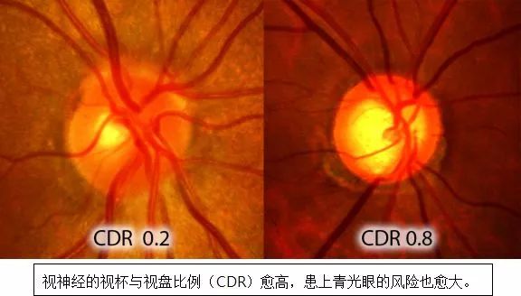 rnfl的厚薄是诊断青光眼的重要指标之一,用光学相干断层扫描(简称oct)