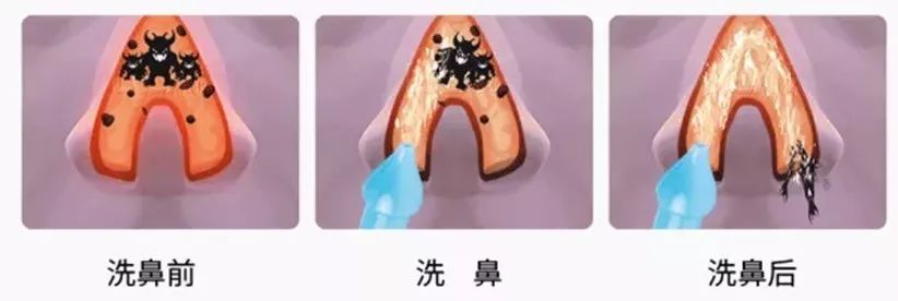 医生给出了帮助小女孩缓解鼻炎症状的方法: 首先,每天给宝宝清洗鼻腔