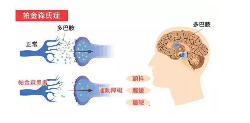 帕金森人口_半数帕金森病人生活质量堪忧(2)