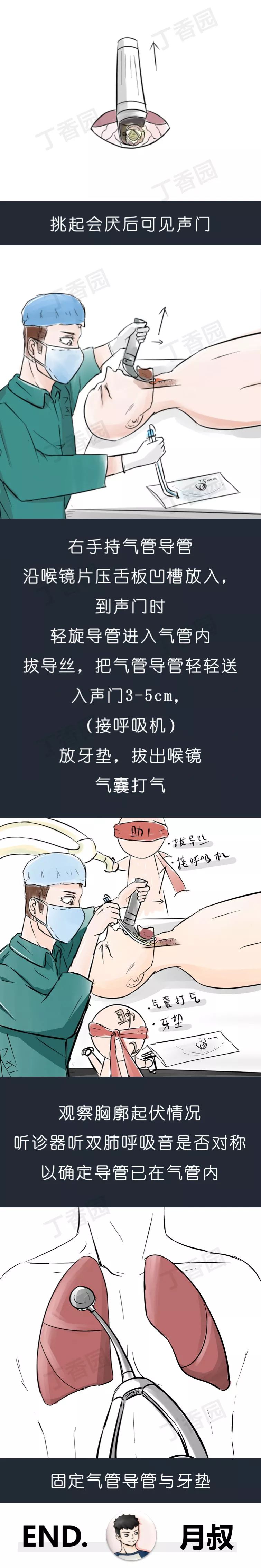 超详细「气管插管」步骤