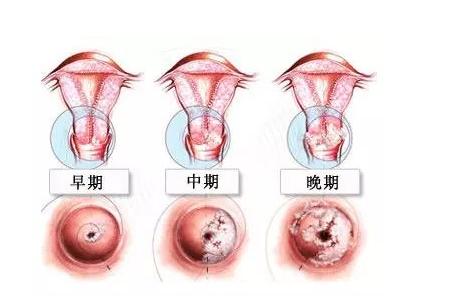 38岁女子经血不断,查出宫颈癌,病床前痛哭:与丈夫脱不