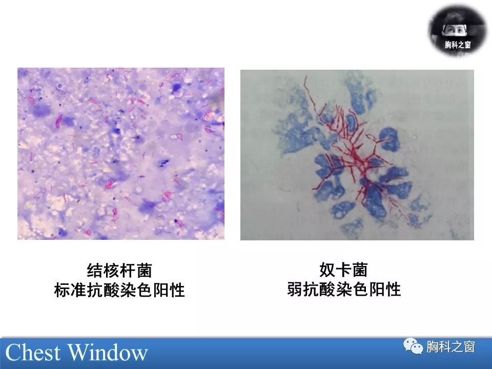 肺奴卡菌病的临床与影像