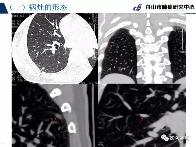 宽基底 窄基底 直边征 胸膜增厚或凹陷 血管征 空气支气管征 随访时间