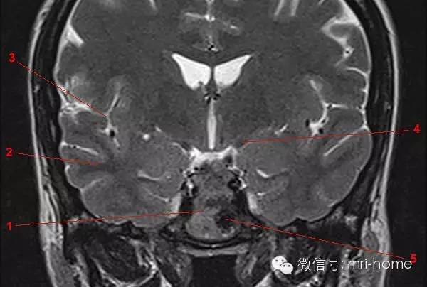 鞍区,垂体磁共振(mri)解剖——冠状面