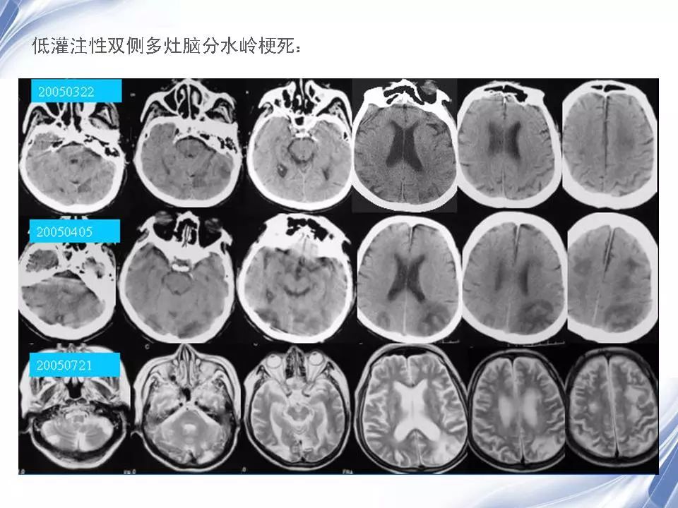 脑分水岭梗死 | 影像天地