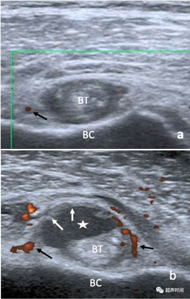 中沟的斜深血管和肱二头肌间沟内的旋前动脉升支在能量多普勒超声检查