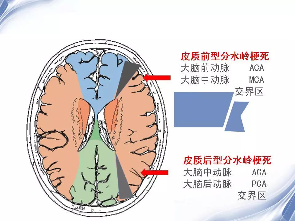 脑分水岭梗死 | 影像天地