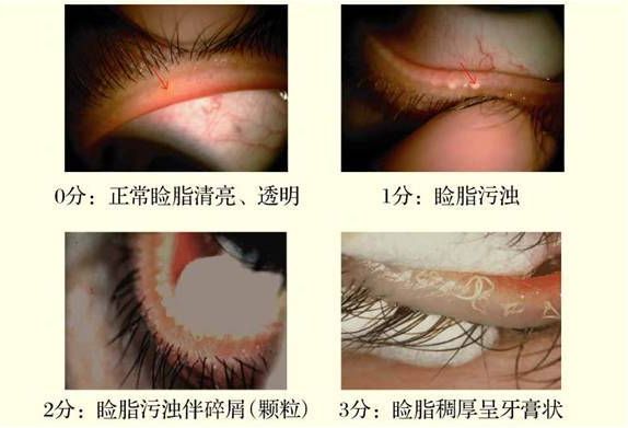 认识睑板腺功能障碍