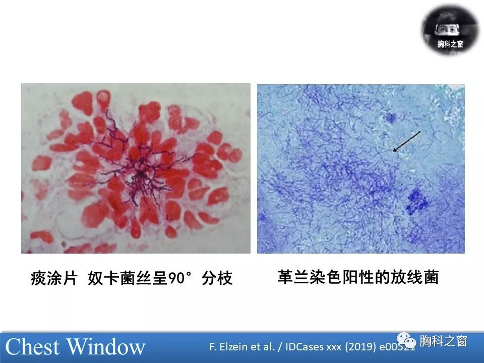 肺奴卡菌病的临床与影像