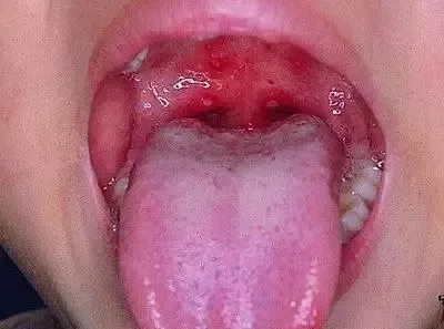                     疱疹性咽炎比手足口病更可怕？识别危重信号及时就诊最重要！