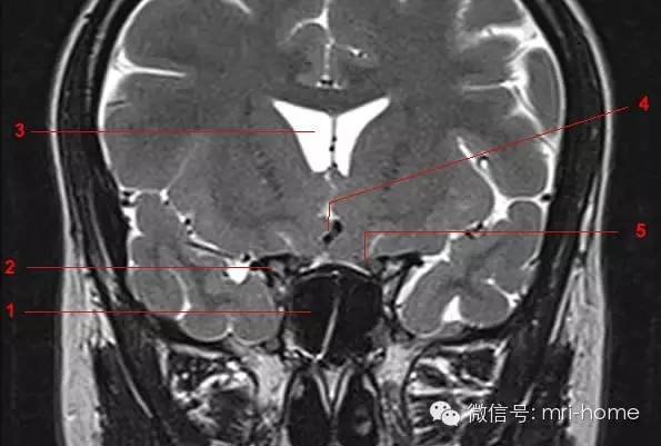 鞍区垂体磁共振mri解剖冠状面