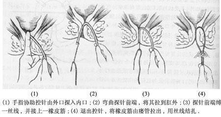 肛门潮湿有分泌物,有三种病因,一种情况可致癌,需要