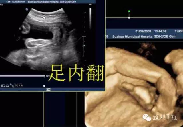 胎儿足内翻超声诊断与处理