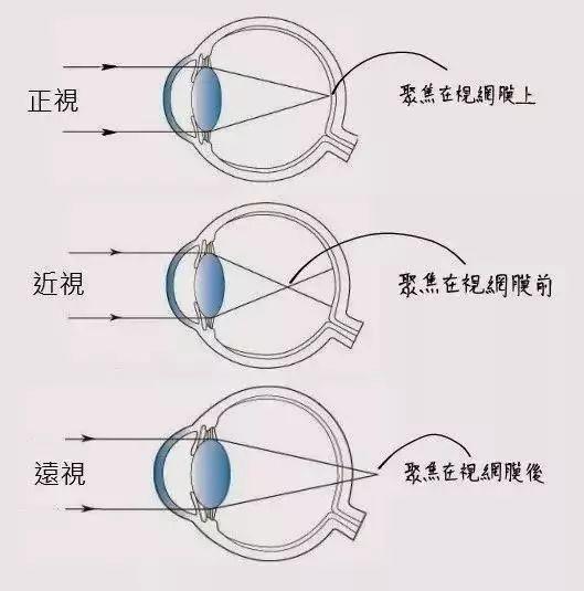 孩子既近视又远视怎么办屈光参差如何正确配镜