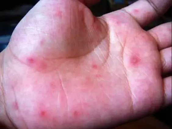                     疱疹性咽炎比手足口病更可怕？识别危重信号及时就诊最重要！