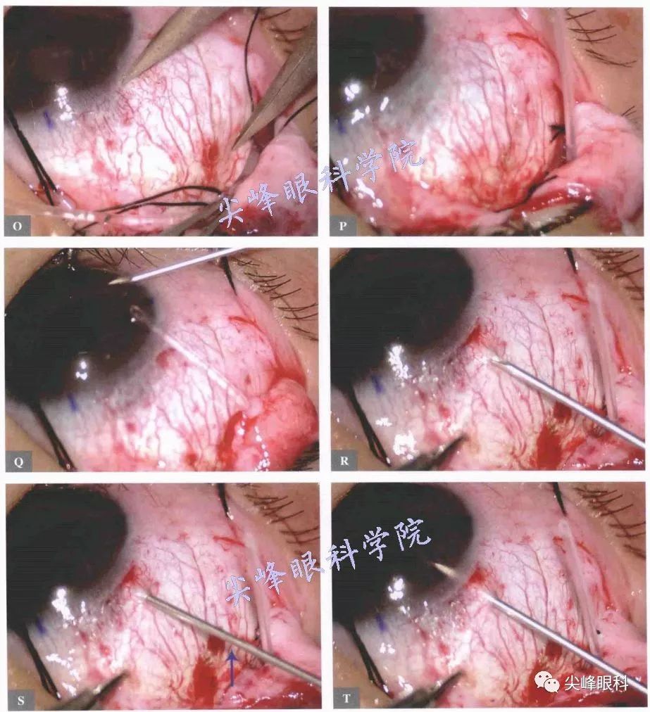 房水引流阀植入手术之手术操作part03图解青光眼手术操作与技巧049