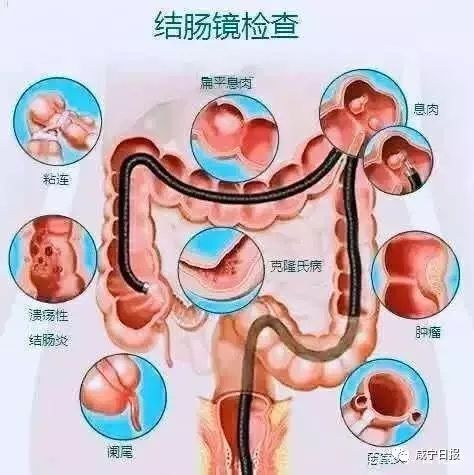 发生在盲肠(包括阑尾),结肠和直肠等部位的大肠肿瘤,临床上较小肠