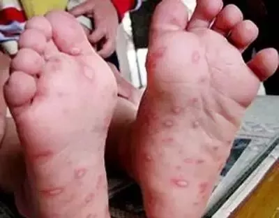                     疱疹性咽炎比手足口病更可怕？识别危重信号及时就诊最重要！
