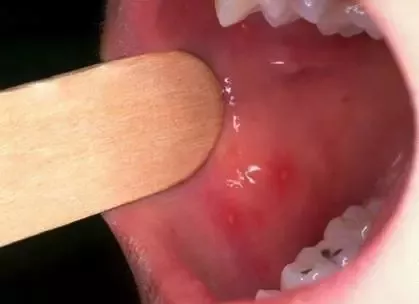                     疱疹性咽炎比手足口病更可怕？识别危重信号及时就诊最重要！