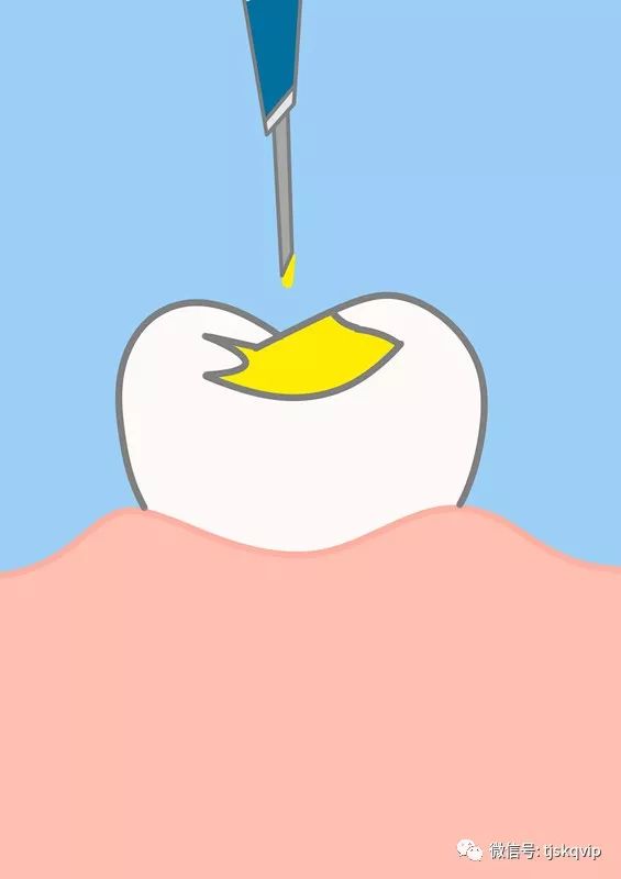 【口腔微学院】图解窝沟封闭,让您一秒就看懂!_牙齿