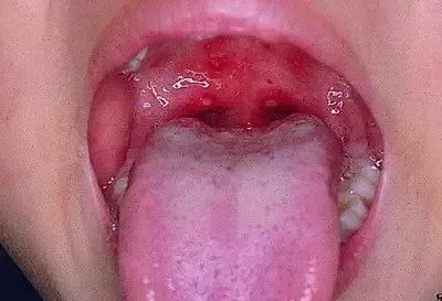                     疱疹性咽炎比手足口病更可怕？识别危重信号及时就诊最重要！
