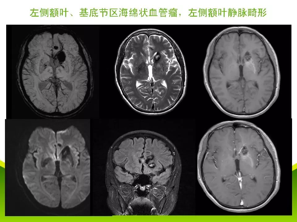 脑血管畸形的影像诊断 | 影像天地