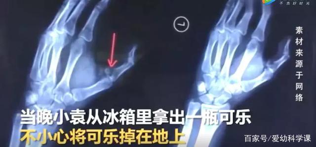                     “砰！”地一声，孩子惨叫，脸上被缝足足38针，只因开了一罐饮料