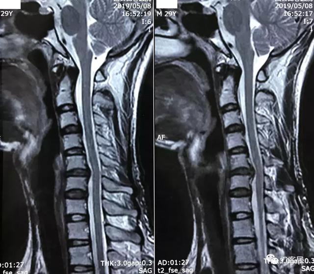 神经根型颈椎病保守治疗的比较