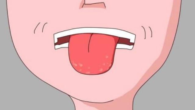 舌苔发白有红点艾滋病图片_纵览新闻