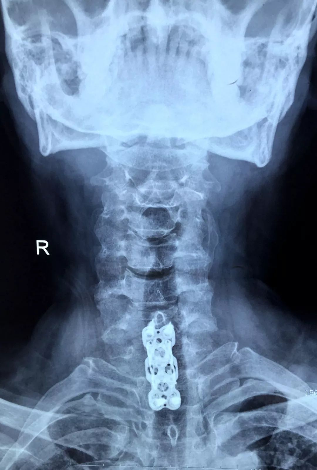 颈椎间融合器 - Rebar - Atlas Spine - 前入路 / PEEK材质