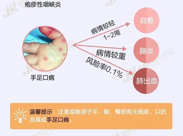                     幼儿园疱疹性咽峡炎进入高发期，这些防护知识家长要知道