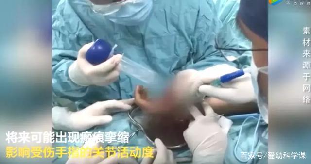                     “砰！”地一声，孩子惨叫，脸上被缝足足38针，只因开了一罐饮料