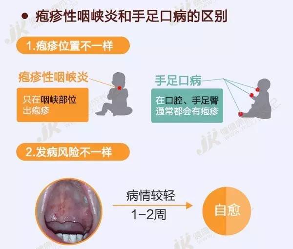                     幼儿园疱疹性咽峡炎进入高发期，这些防护知识家长要知道