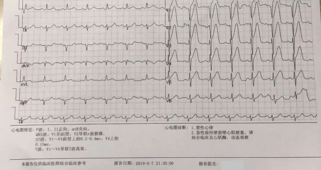 首份心电图:急性前壁心肌梗死超急性期